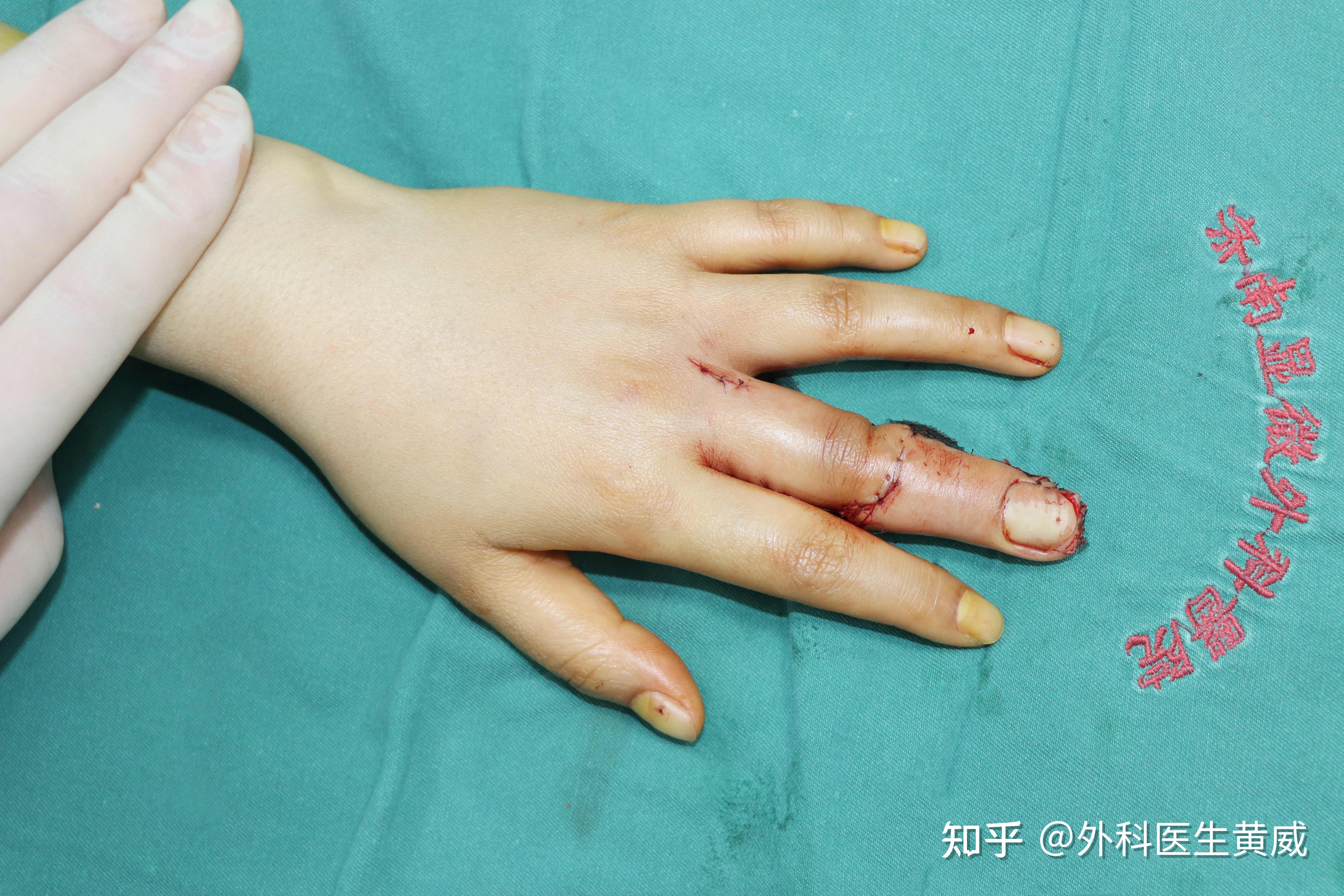 专业再造技术,重塑健全手指