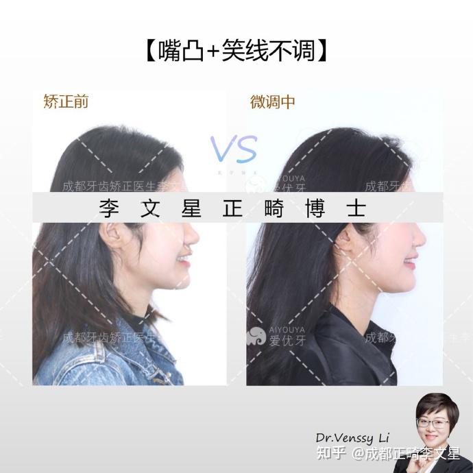 成都牙齿矫正丨笑线改善，让笑容重现 - 知乎