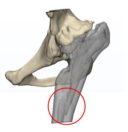 02换髋手术遇难题,如何选择合适的股骨柄型号?