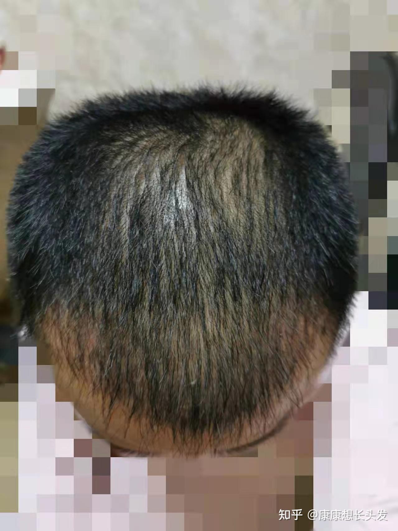 脱发7年花了近5万我都踩过哪些坑又有哪些值得分享的建议避坑建议