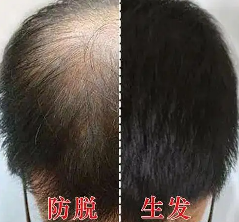 生发液哪款好?别再胡乱选择生发精华,附6款亲身体验的生发液推荐!