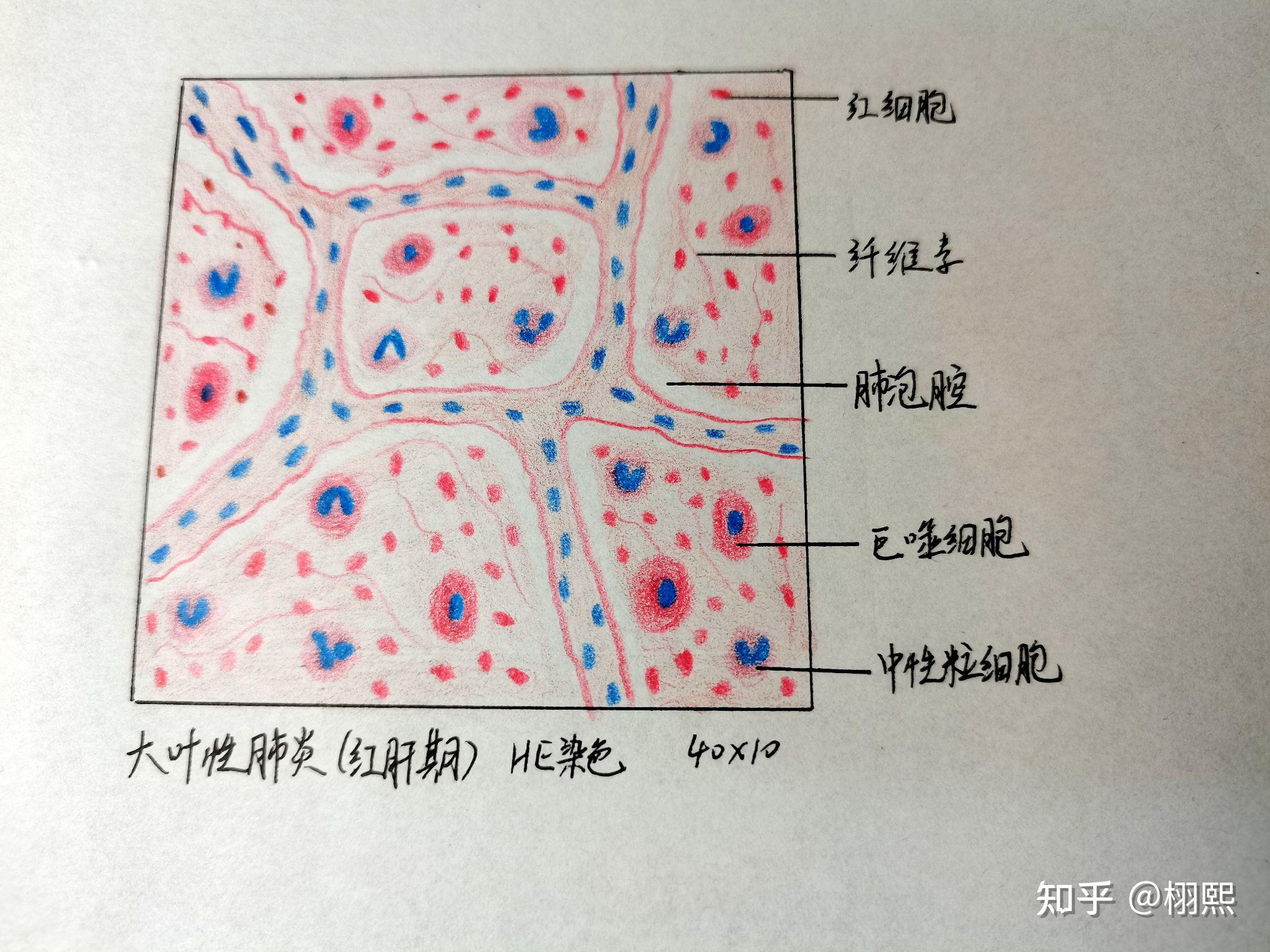 红蓝铅笔浆细胞图片