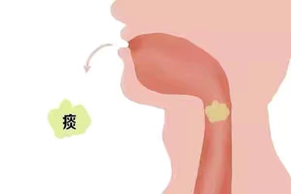 吐出的痰液颜色不同说明了什么?黑痰、黄痰、白痰,哪个更严重? - 知乎