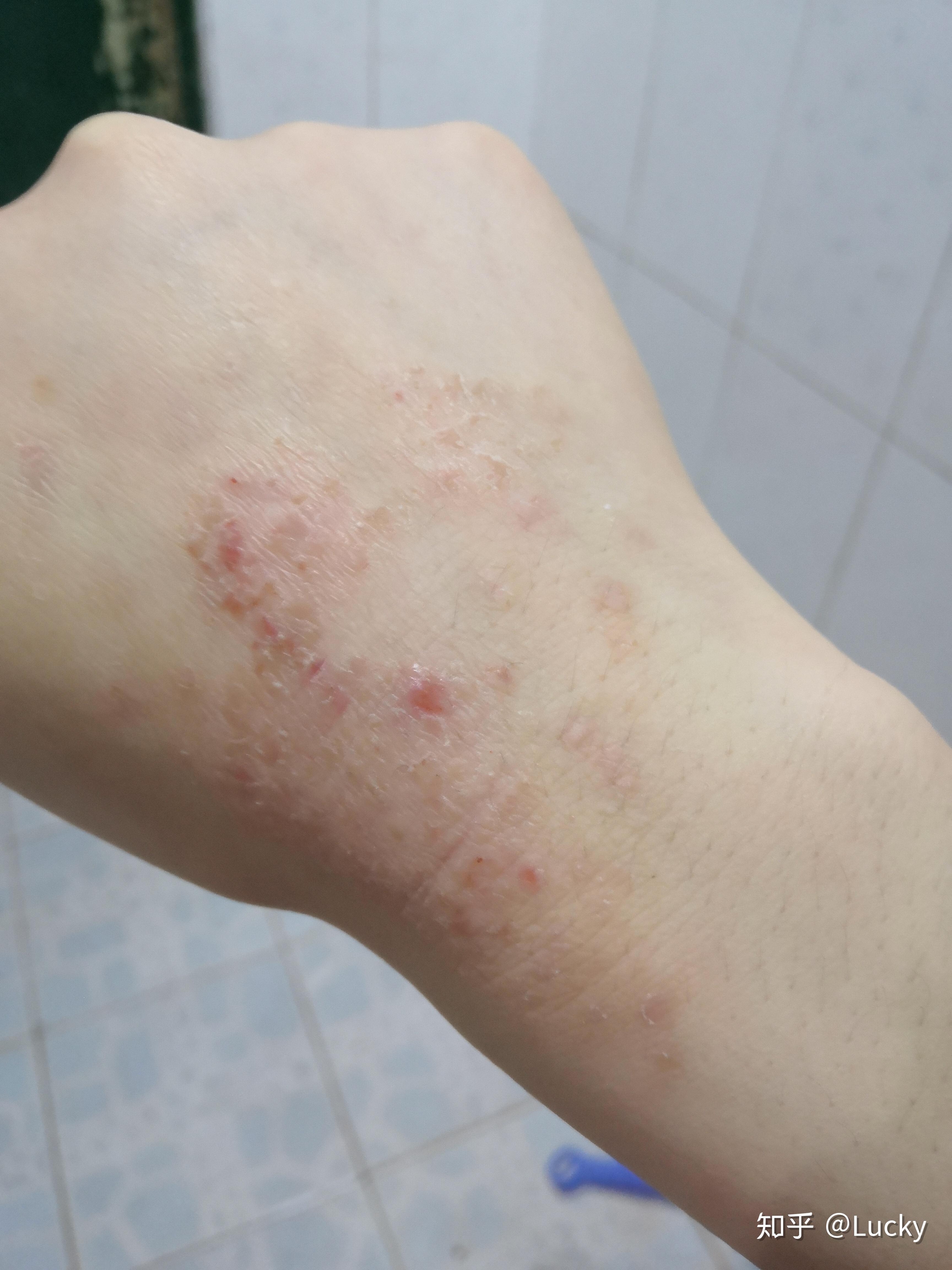 手上起了湿疹怎么治疗