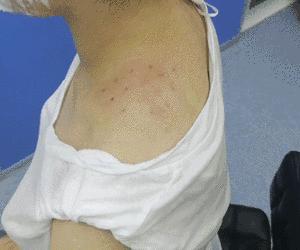 肉毒素瘦肩瘦胳膊亲测| 从肌肉的角度打造直角肩