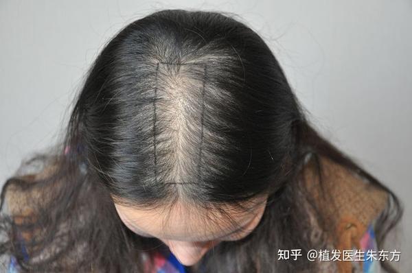 发缝变宽、发缝稀疏该如何拯救 - 知乎