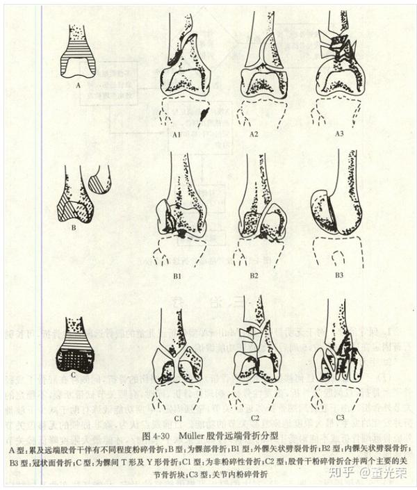 股骨骨折分型图解图片