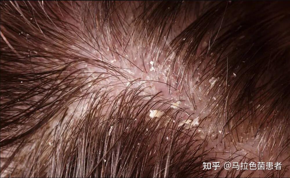 马拉色菌不致病一旦繁殖真要命