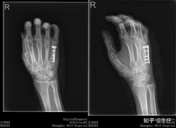 右手第五掌骨骨折 术后3周 说下现在恢复情况 知乎