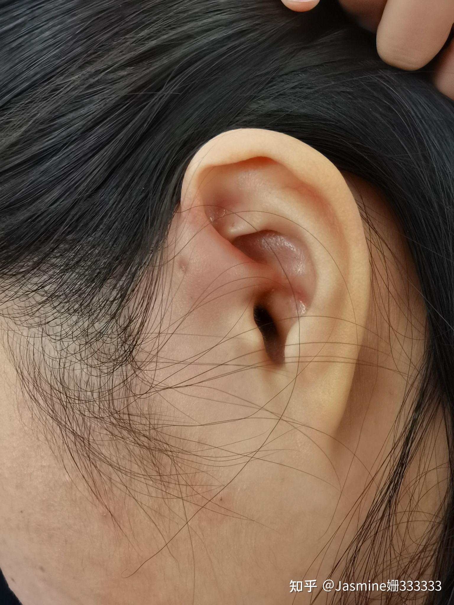 先天性耳前瘘管，发炎一次建议最好选择手术_先天性耳前瘘管_先天性耳前瘘管治疗方式 - 好大夫在线