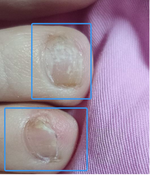 之前发现指甲变厚现在剪指甲发现指甲有一部分变粉状是灰指甲吗