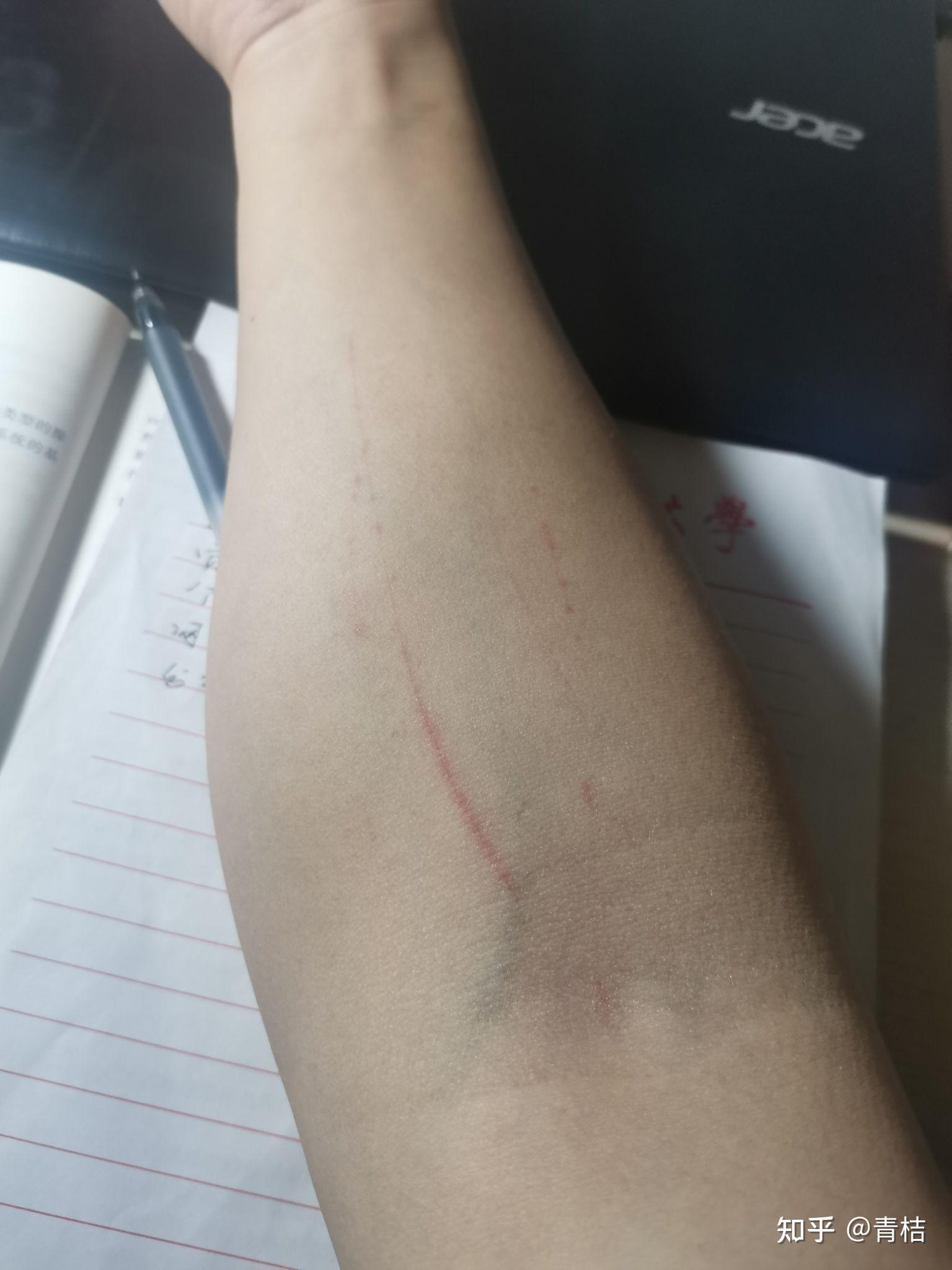 手臂莫名其妙出现伤痕是怎么回事? - 知乎