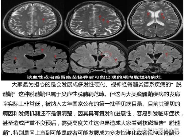 脑白质脱髓鞘图片