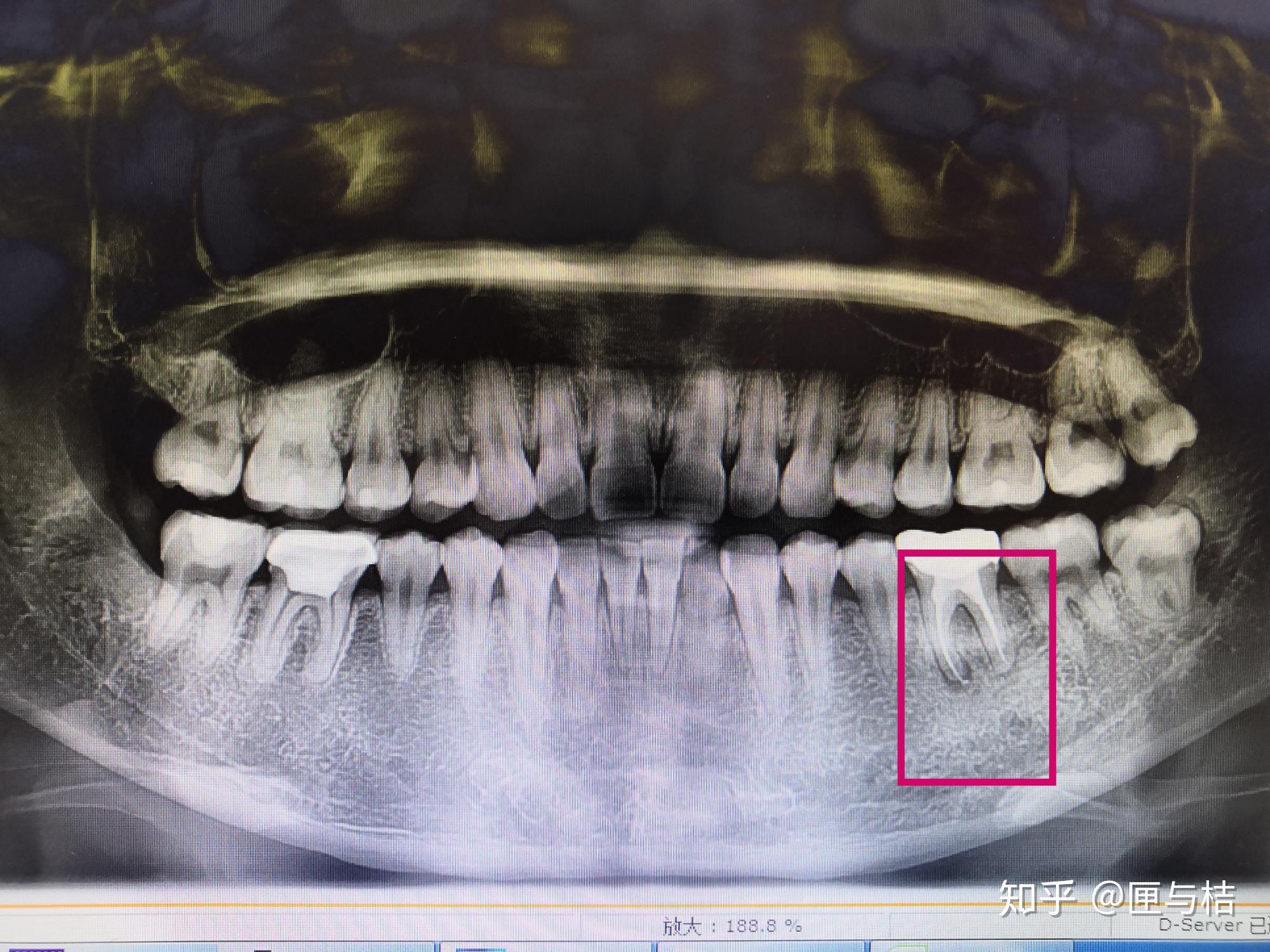 急谢谢路过大神帮助根管治疗后的牙根尖发炎需要洗牙