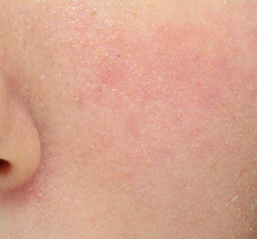 面色发红红血丝头皮屑多您可能患有脂溢性皮炎