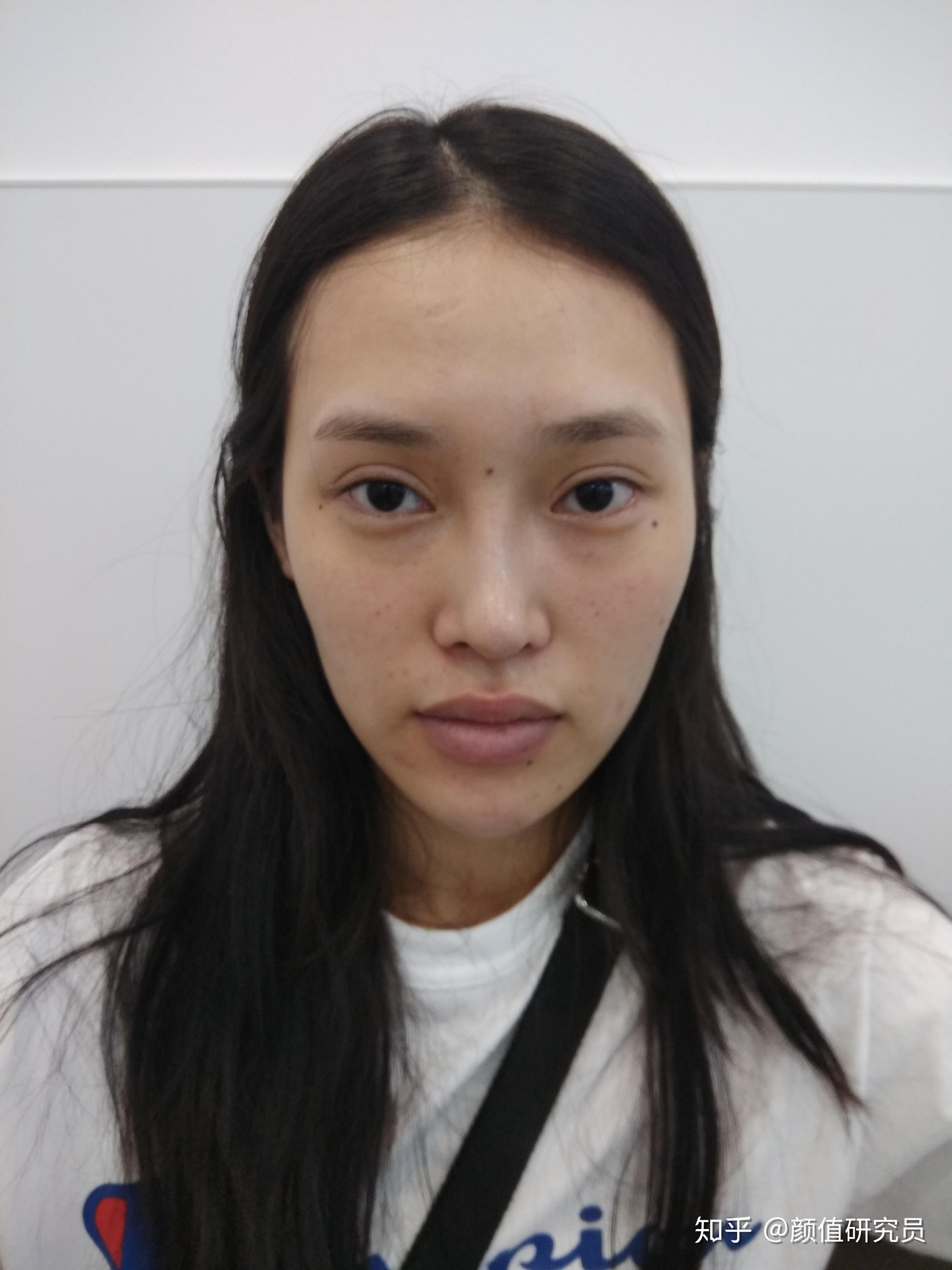 嘴唇肉多噘嘴可以吸脂解决吗? - 知乎