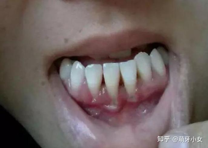 牙龈萎缩后能修复吗?