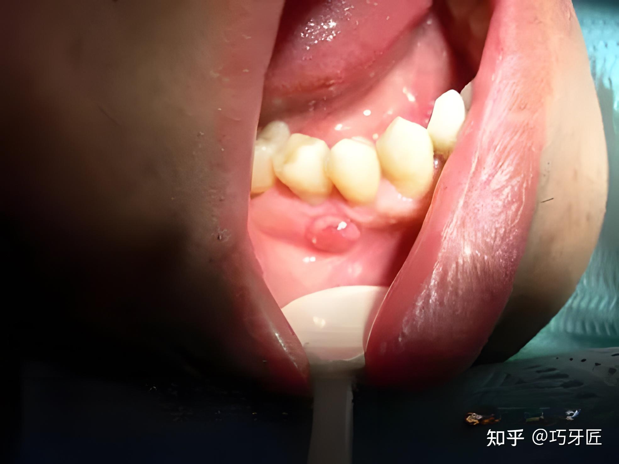关于智齿(第八颗牙)四颗长不出来的智齿智齿反复发炎造成的颊瘘,脓肿