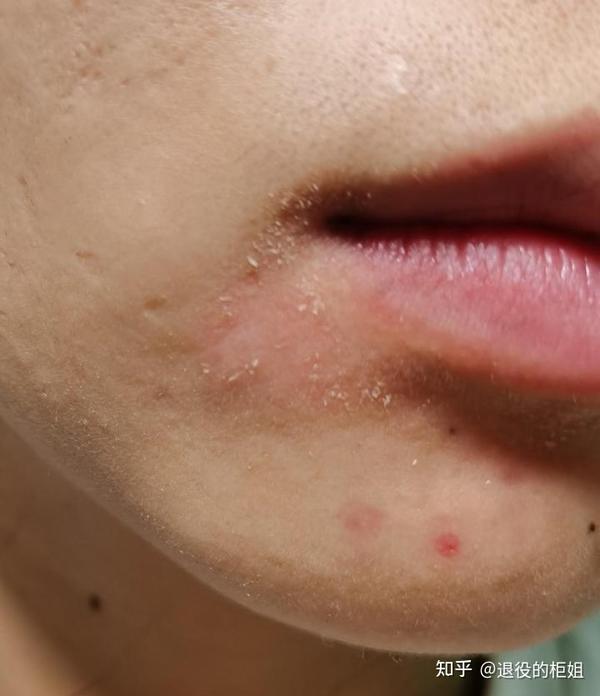 嘴巴左右离下巴的地方老是会发红.痒.