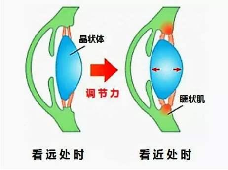 近视眼形成的真正原因:调节性眼压的长时间持续,产生的膨胀力顶着眼轴