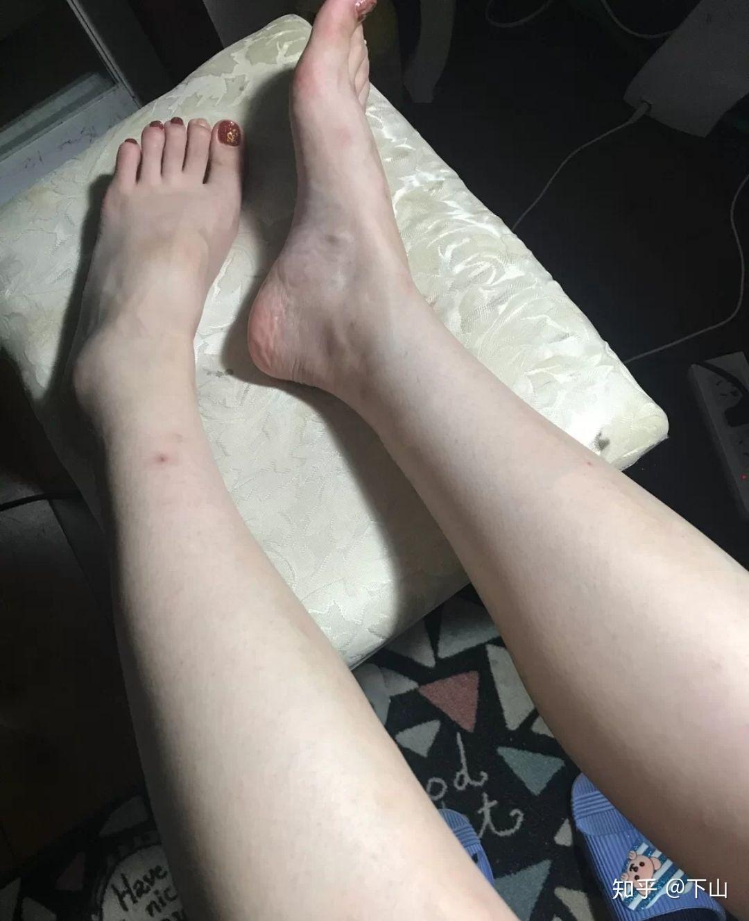 被蚊子咬后,留下疤痕,有神马好方法祛疤? - 知乎