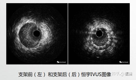 恒宇医疗如何深耕腔内影像学市场，打造OCT、IVUS心血管精准诊疗利器？ - 知乎