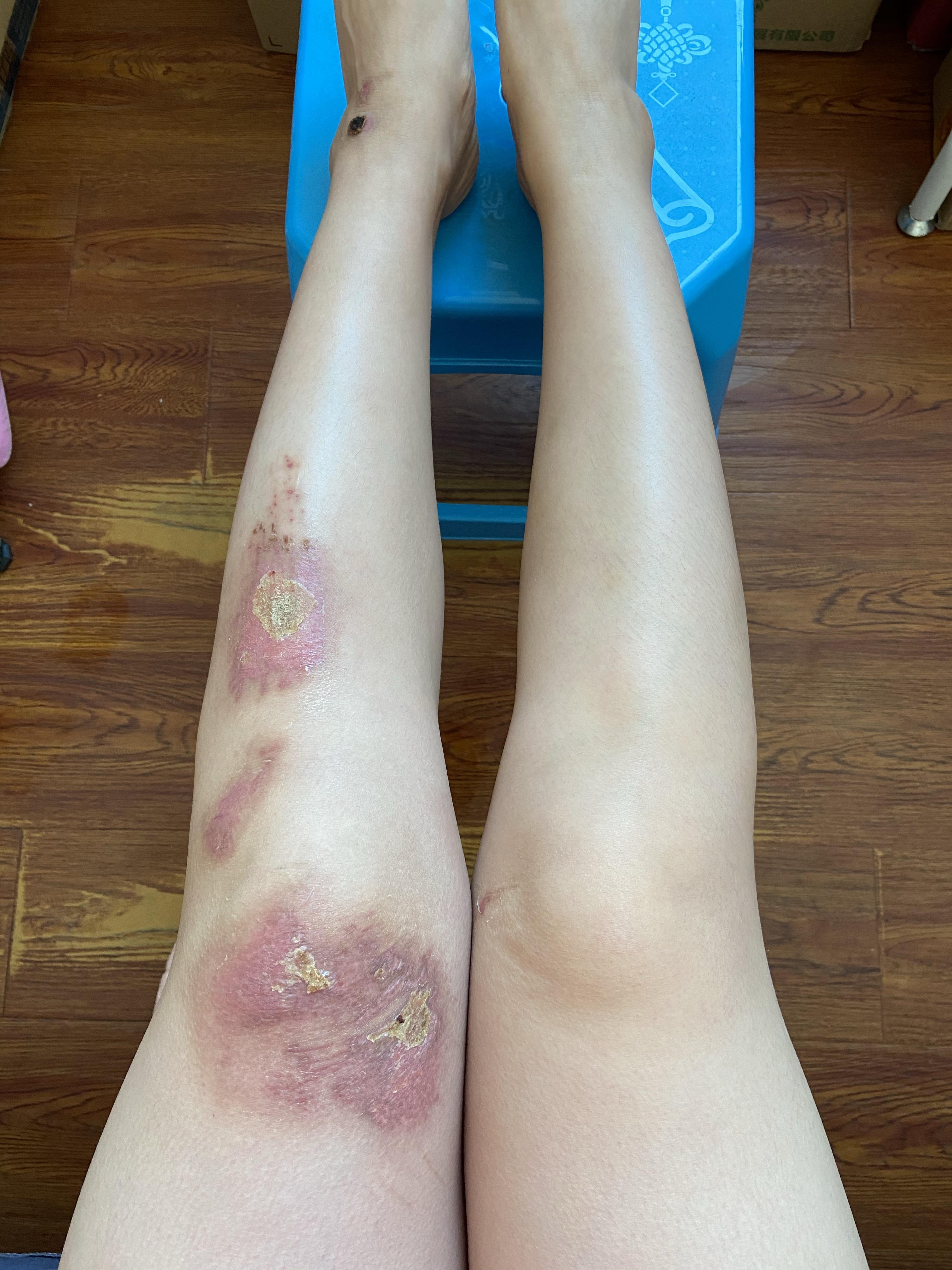 膝盖摔伤,抹了碘伏结痂后如何防止留疤? - 知乎