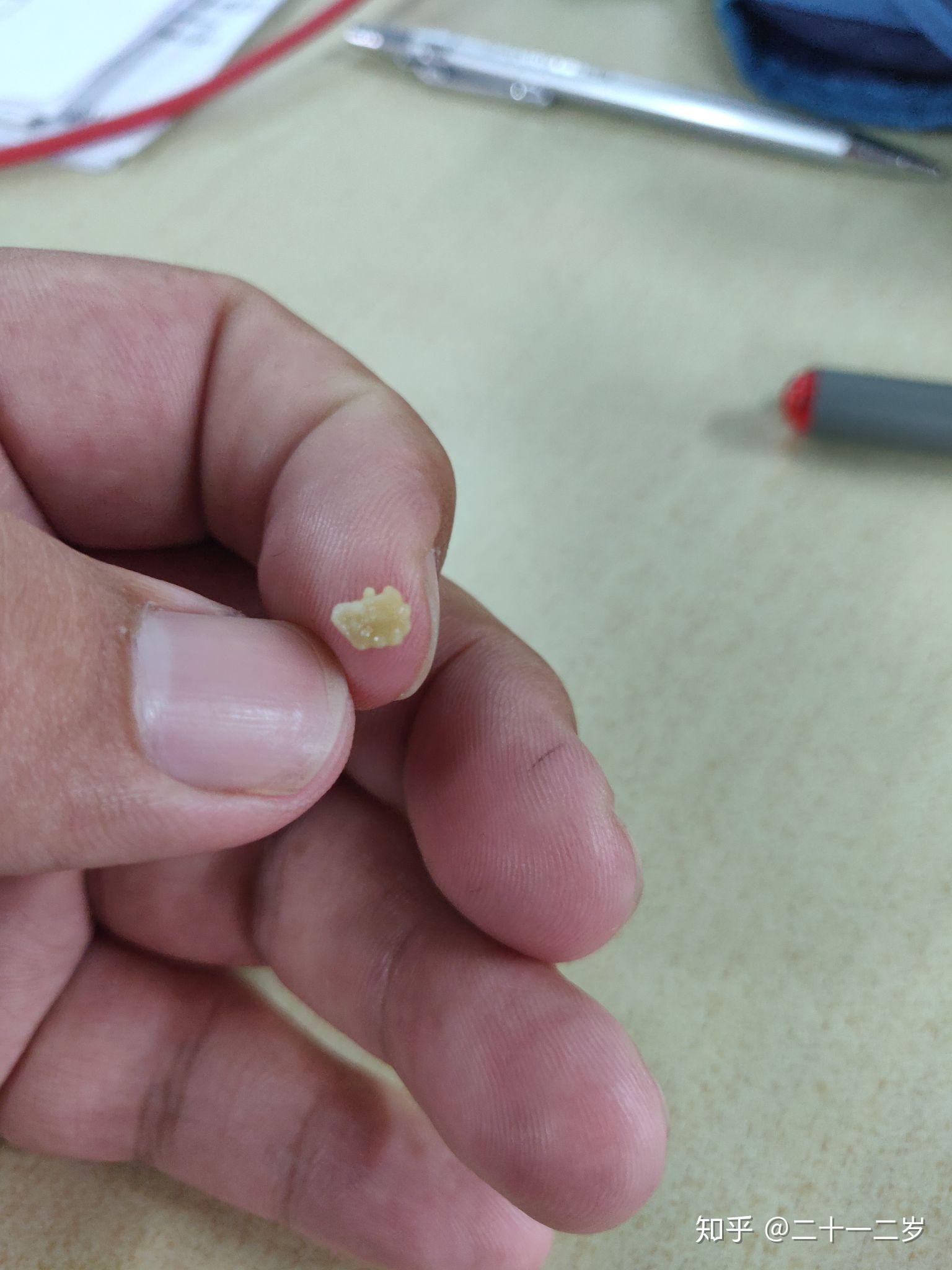 你见过最大的扁桃体结石有多大