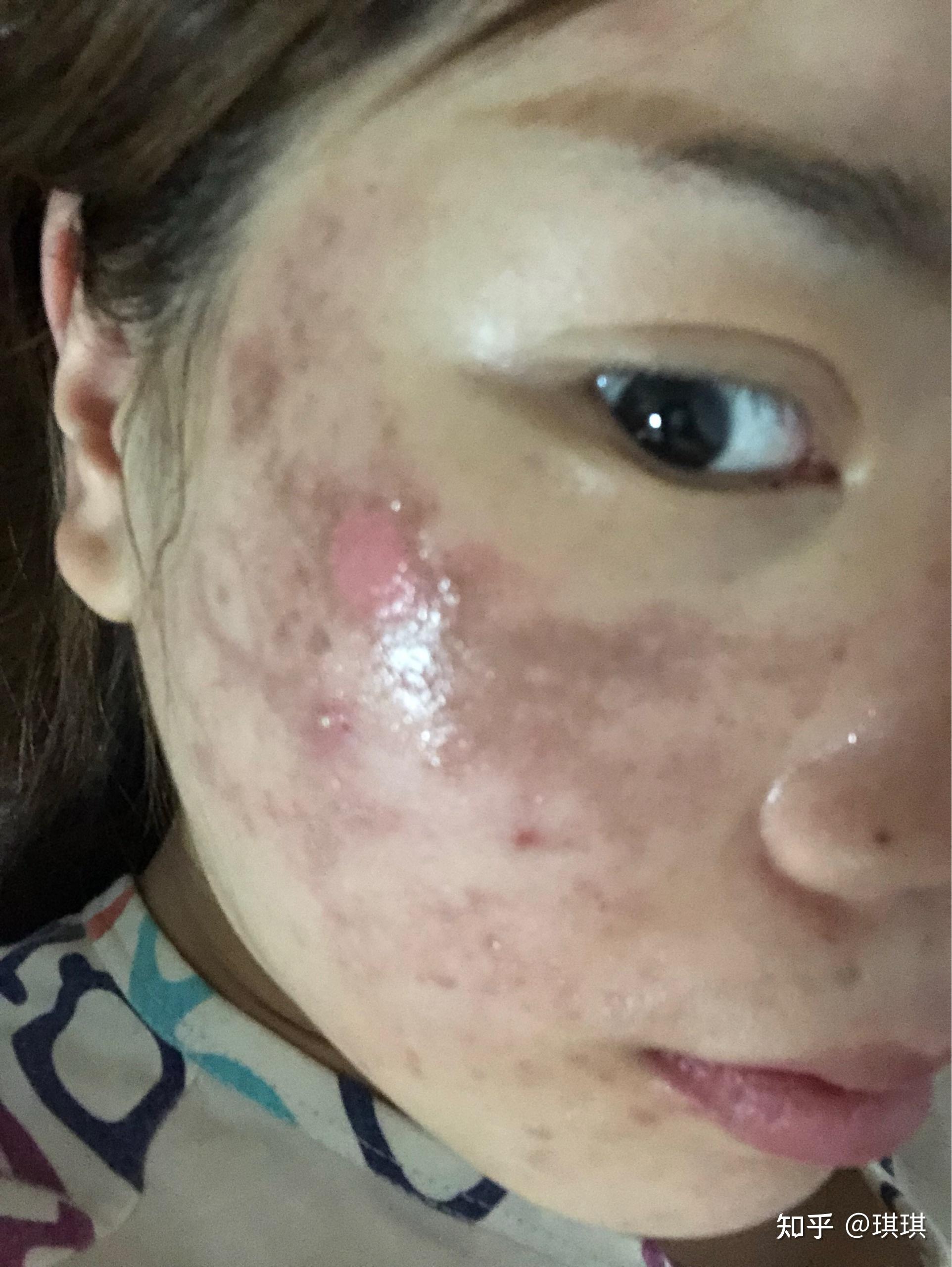 去医院做完水杨酸焕肤脸上烧伤第二天掉皮露出肉怎么办? - 知乎