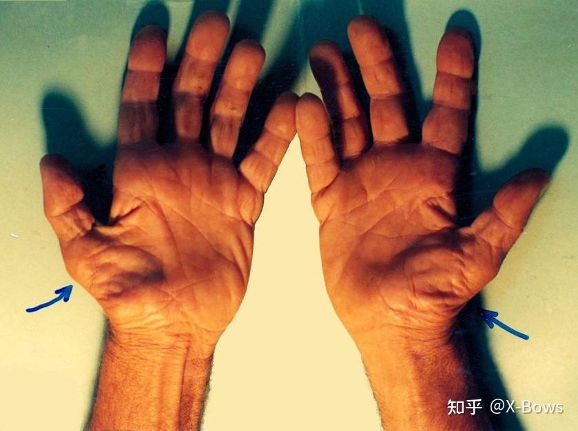 经常打字的人如何预防腕管综合征