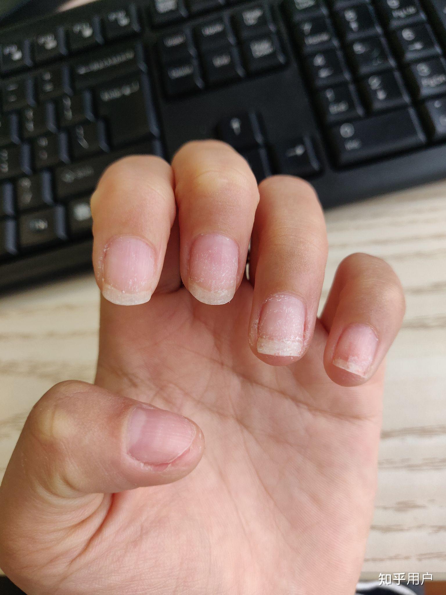 整块指甲抠得基本不剩了这样指甲能不能再长好呢