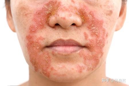 关注脂溢性皮炎与马拉色菌致病机制和治疗转载于好大夫在线