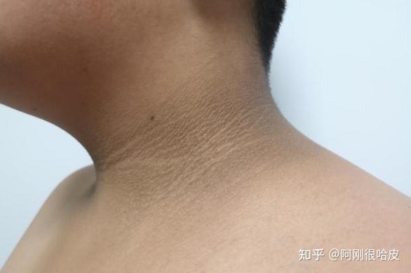 皮肤黑，不是没搓干净！需要警惕这个病~~~ - 知乎