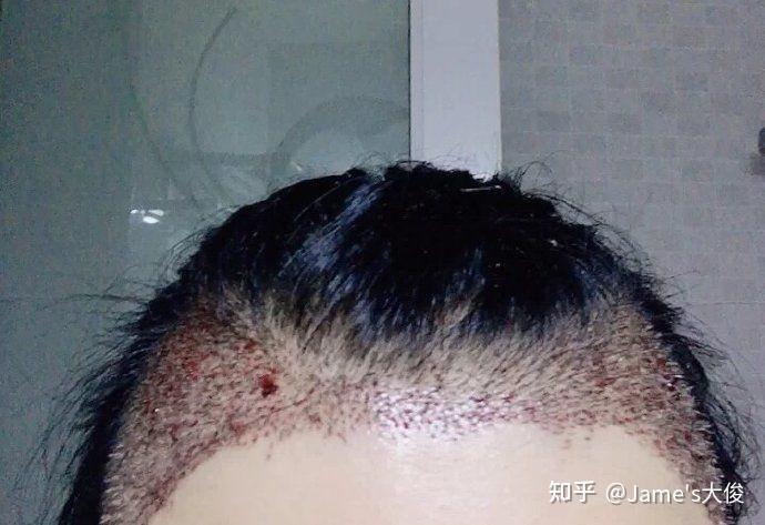 鸡皮疙瘩皮肤科脱发(皮肤鸡皮疙瘩脱皮还痒) 鸡皮疙瘩皮肤科脱发(皮肤鸡皮疙瘩脱皮还痒)