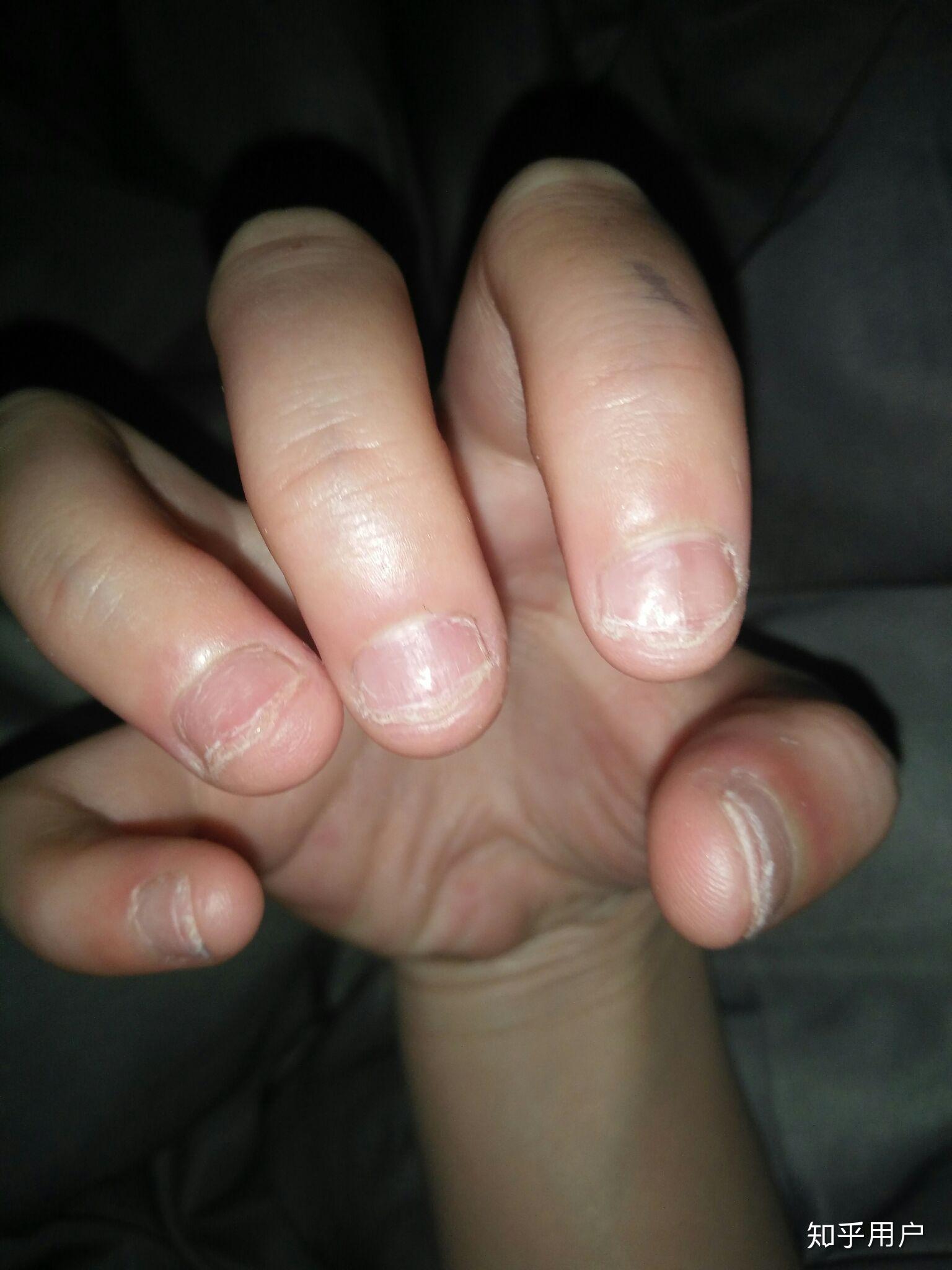 咬手指甲到底是心理问题还是生理问题? - 知乎