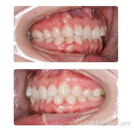 上颌牙弓像 & 下颌牙弓像术者体位:1)拍摄者站在