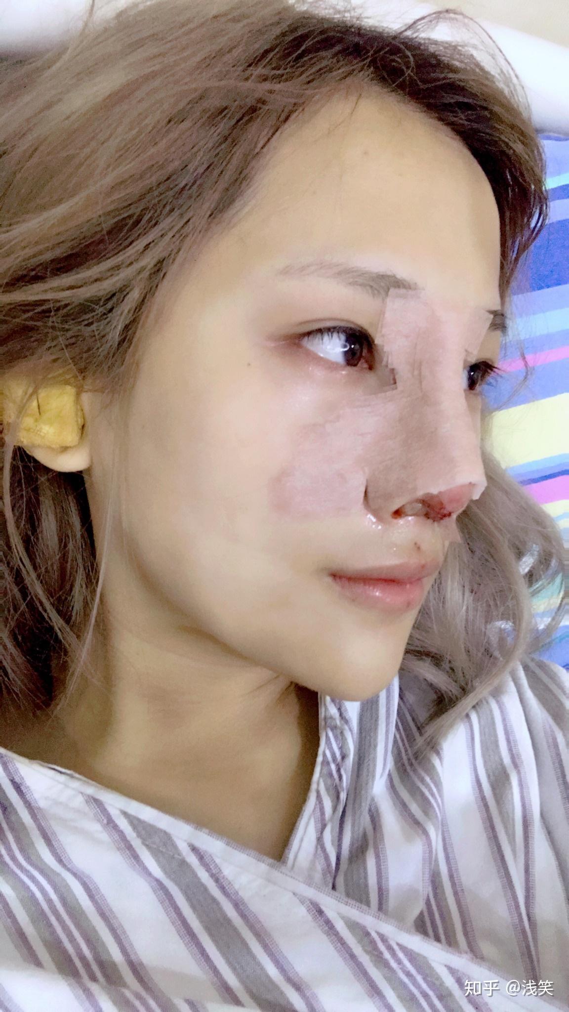 做鼻子的体验和恢复过程