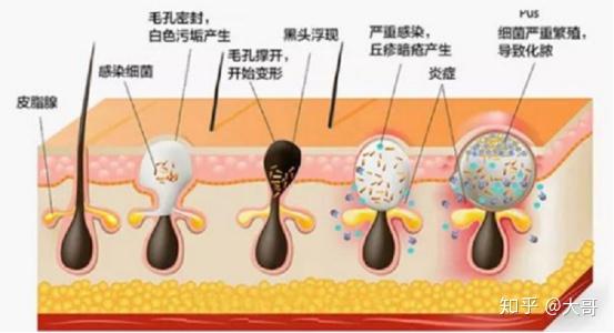 有什么办法不长黑头 v2-5e227e9f06af9ef03ba5677dd98650c8_r.jpg
