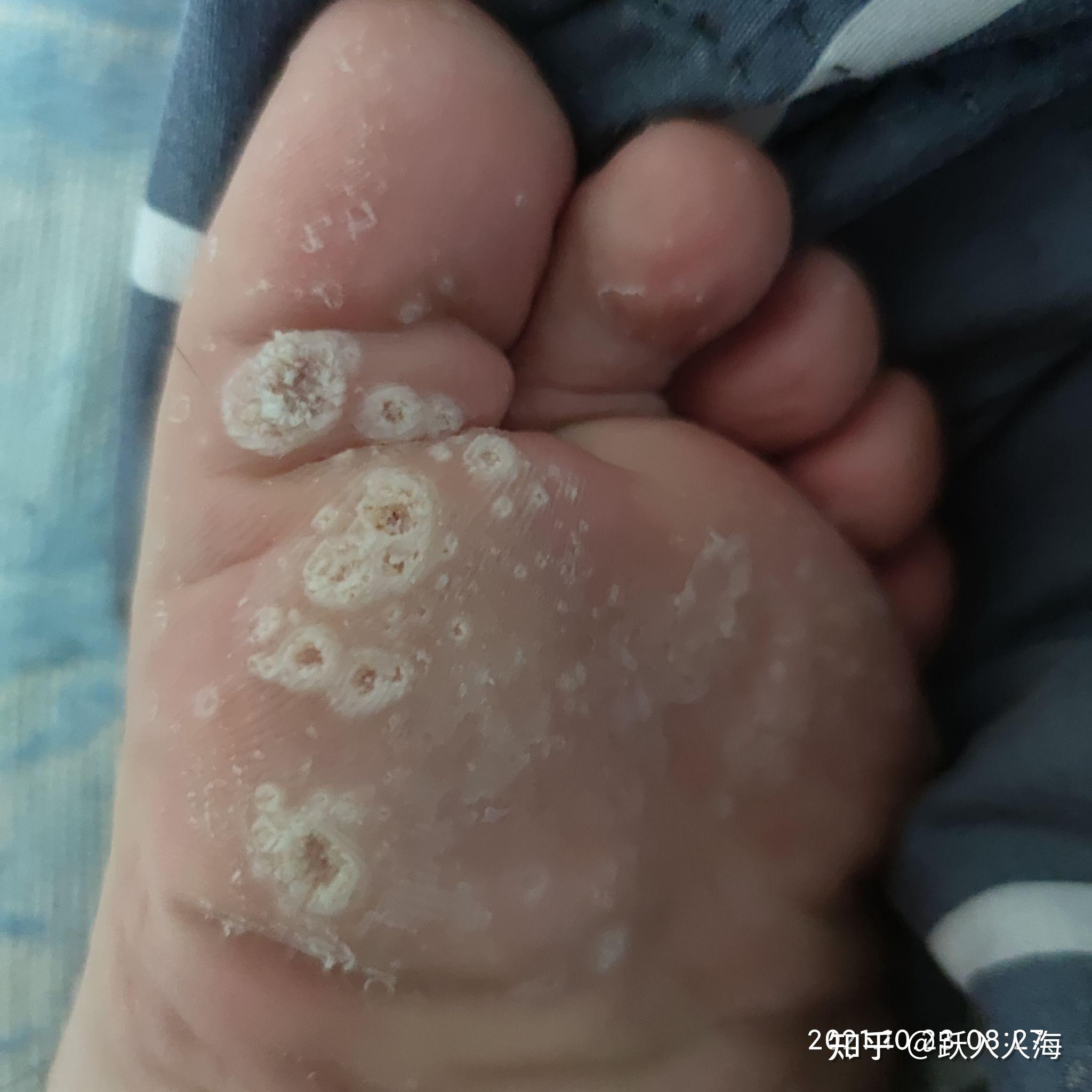 跖疣的自愈性大吗