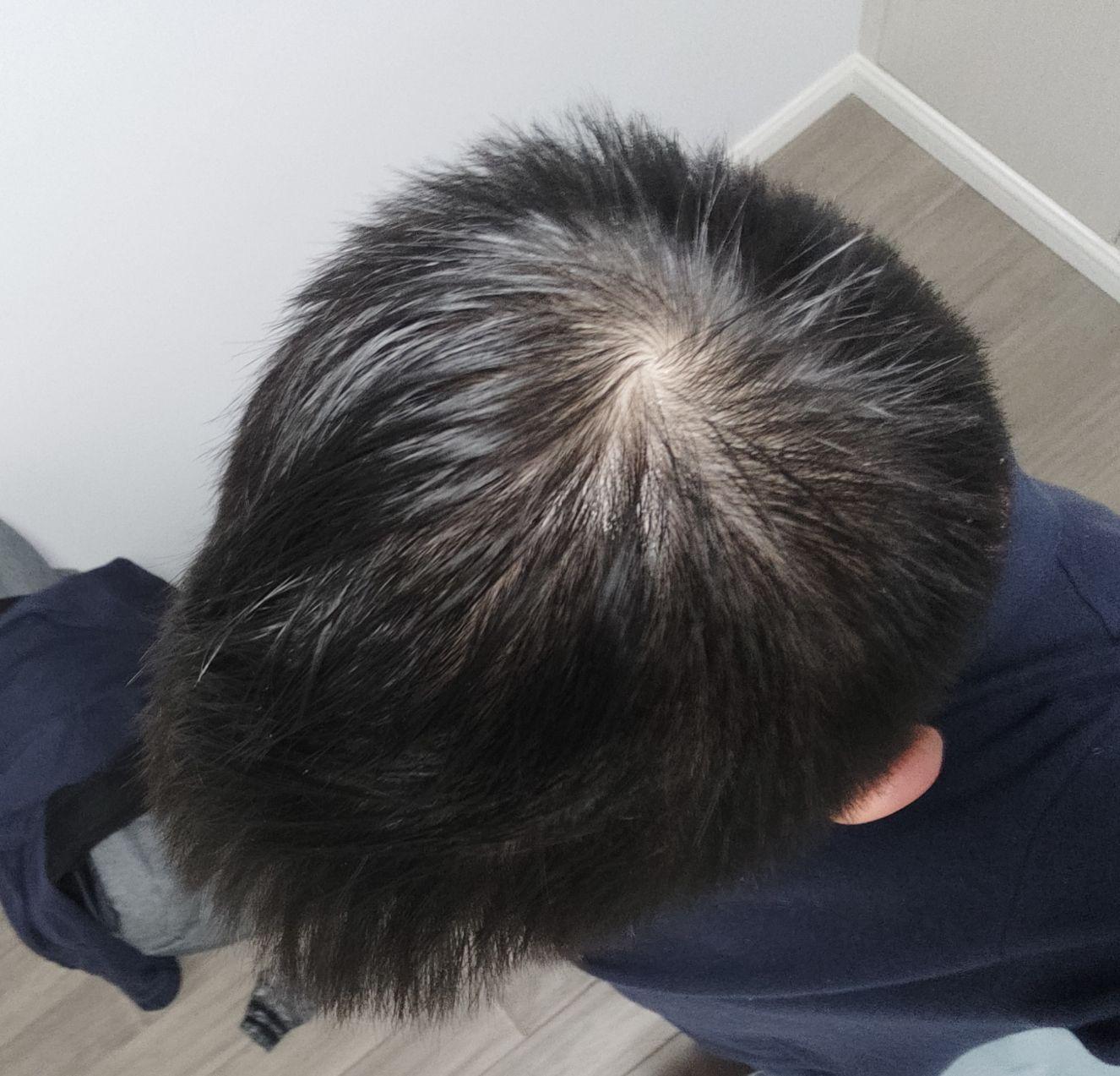 发旋处头发太少了!,我是不是要秃了,怎么办啊! - 知乎