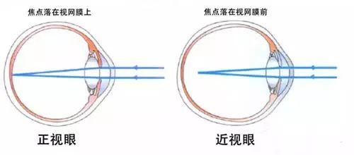 做眼睛近视手术的原理_做近视手术前必须要做眼部检查,医生根据检查的结果,评估你是否适合