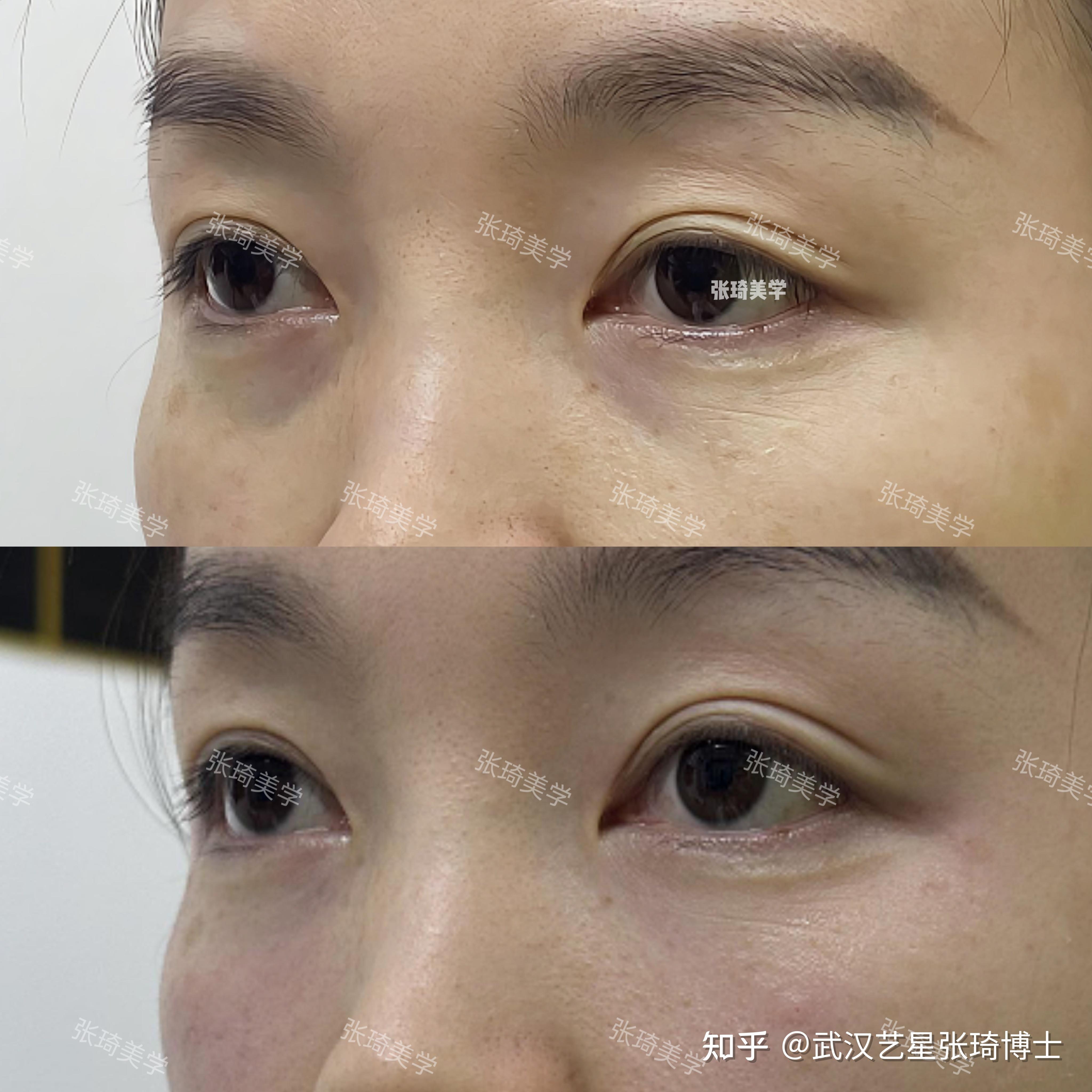 泪沟指的是哪个位置? - 知乎