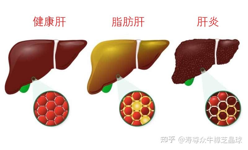 輕度脂肪肝怎麼治療壽尊眾告訴你如何消除脂肪肝