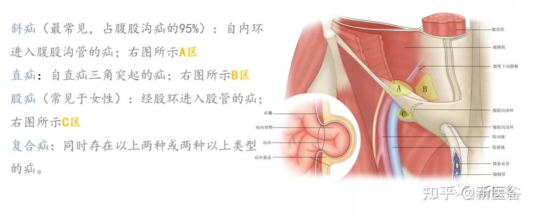 腹股沟斜疝解剖图图片