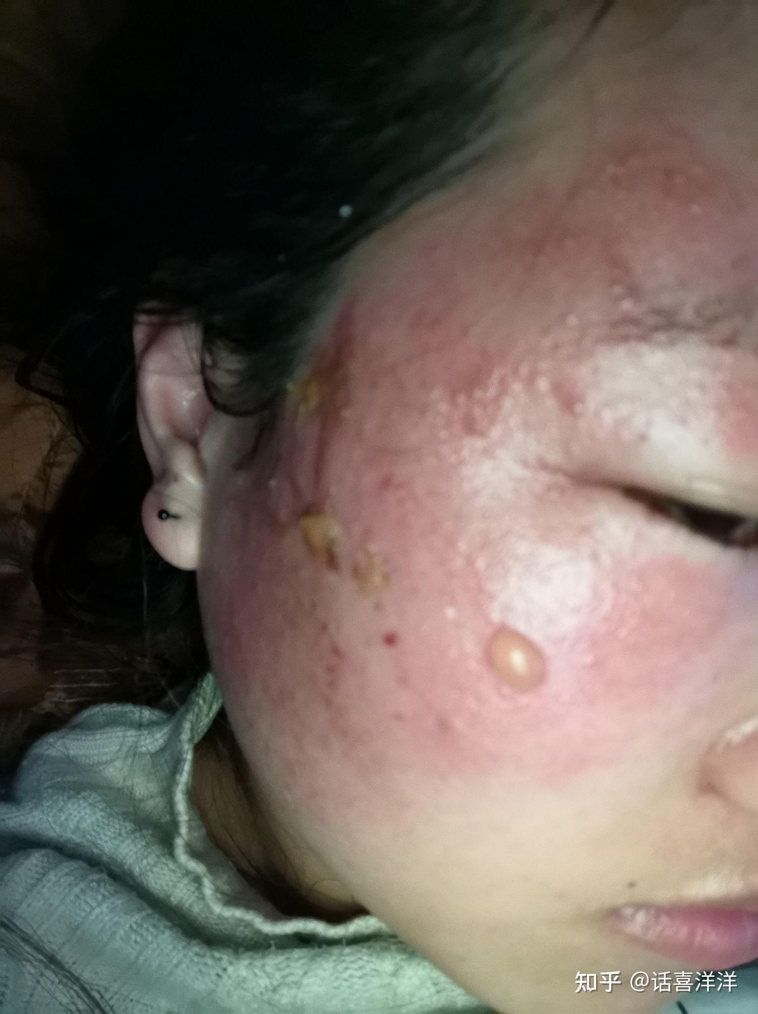 看科普的我,脸上的伤不敢轻易挑战,我又洗掉找到了家里面的紫草烧伤膏