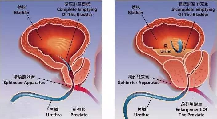 医生万米高空用口吸尿前列腺增生平时该如何保养