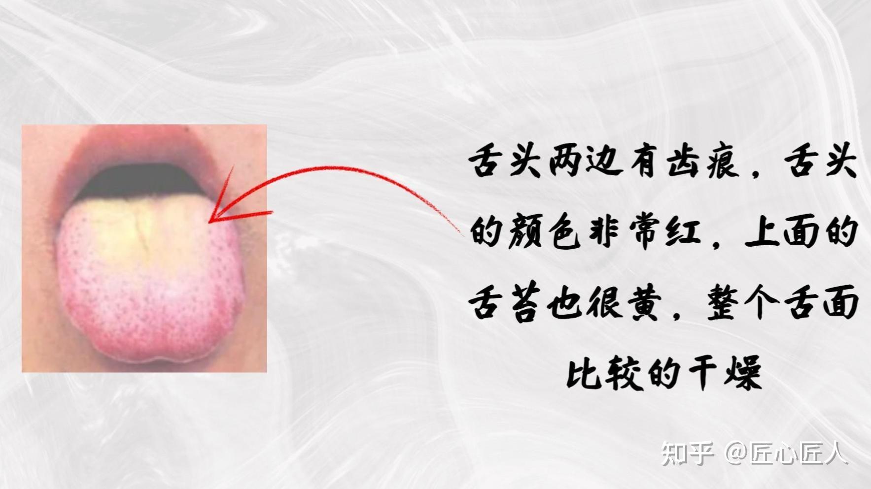 痰湿体质的人舌象都有什么特点? - 知乎