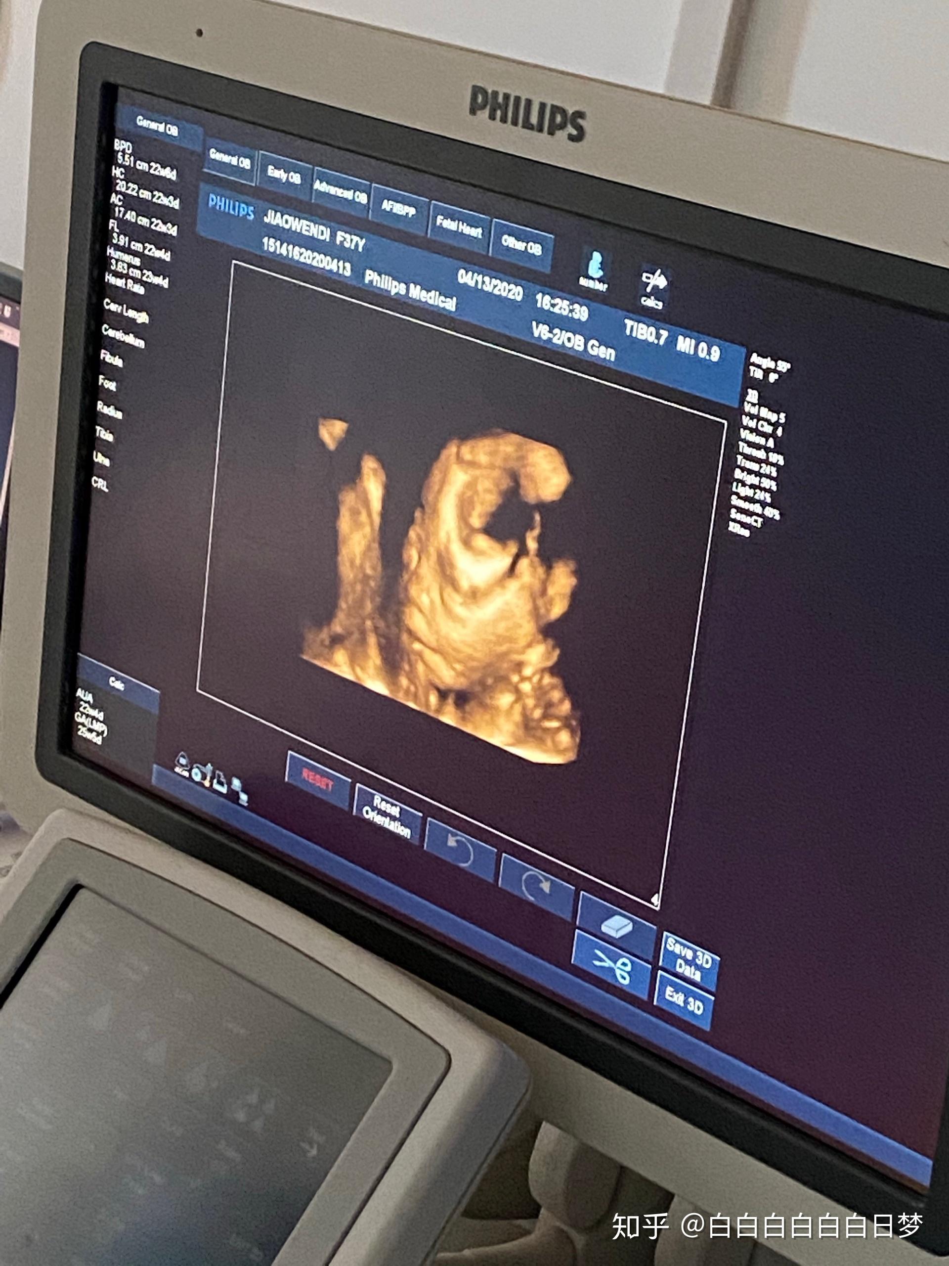 你第一次看到宝宝的四维彩超照片,是什么感觉?
