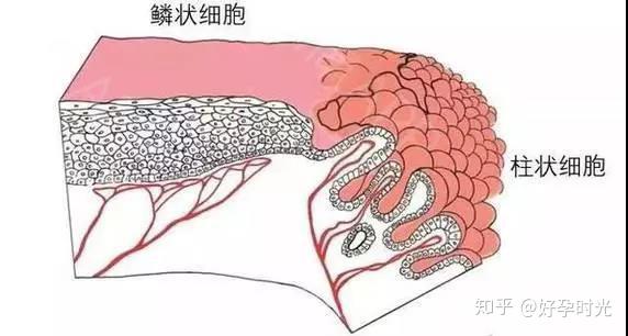 宫颈纳囊——子宫颈上的青春痘 - 知乎