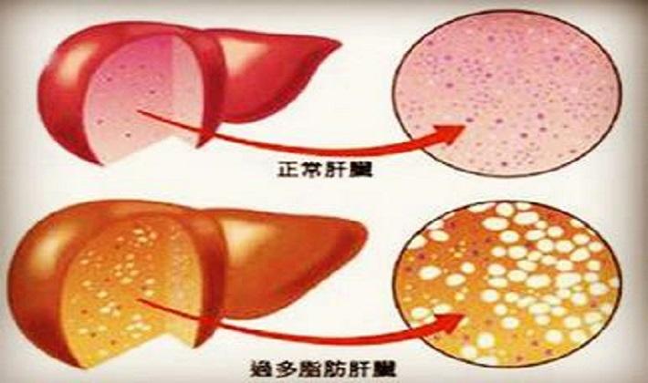 頤君堂科普這幾種人最易得脂肪肝你包含在內嗎